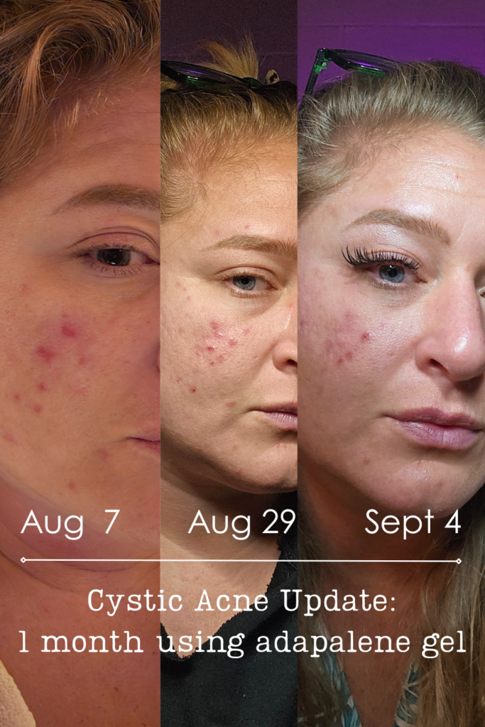 understanding cystic acne