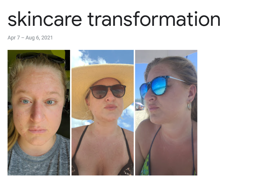 cystic acne transformation