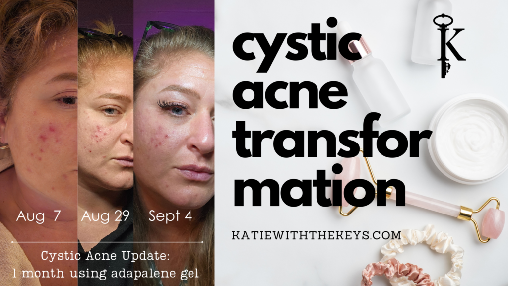 cystic acne transformation