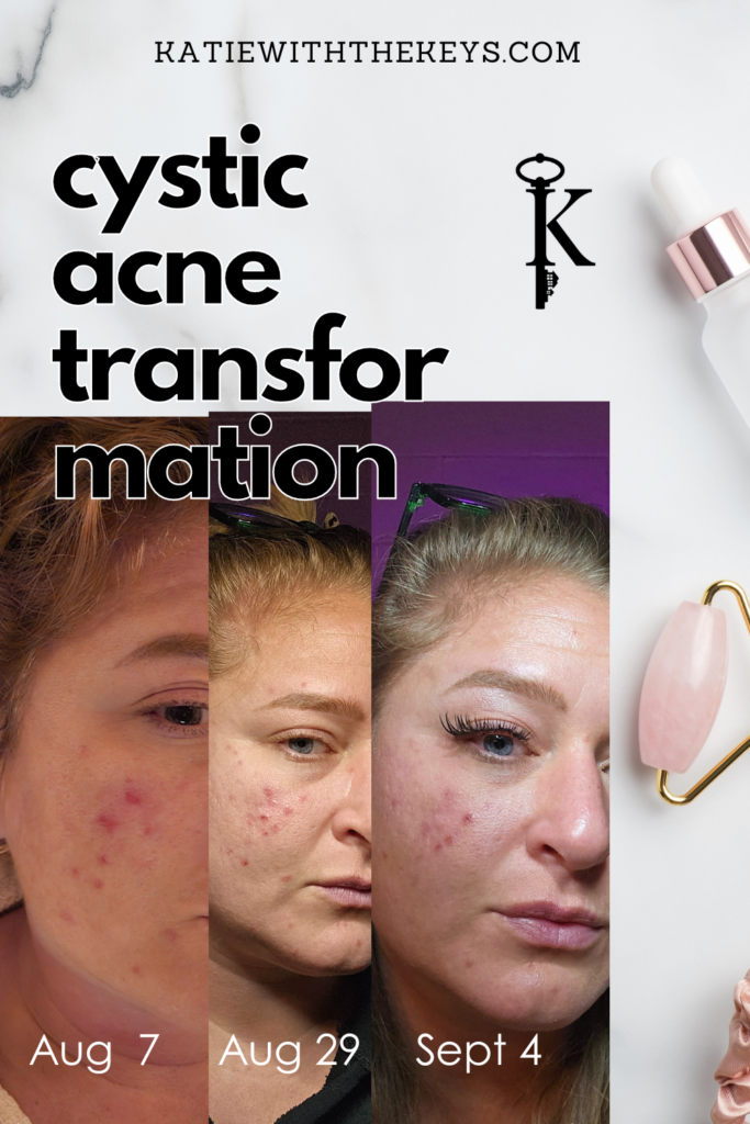 cystic acne transformation